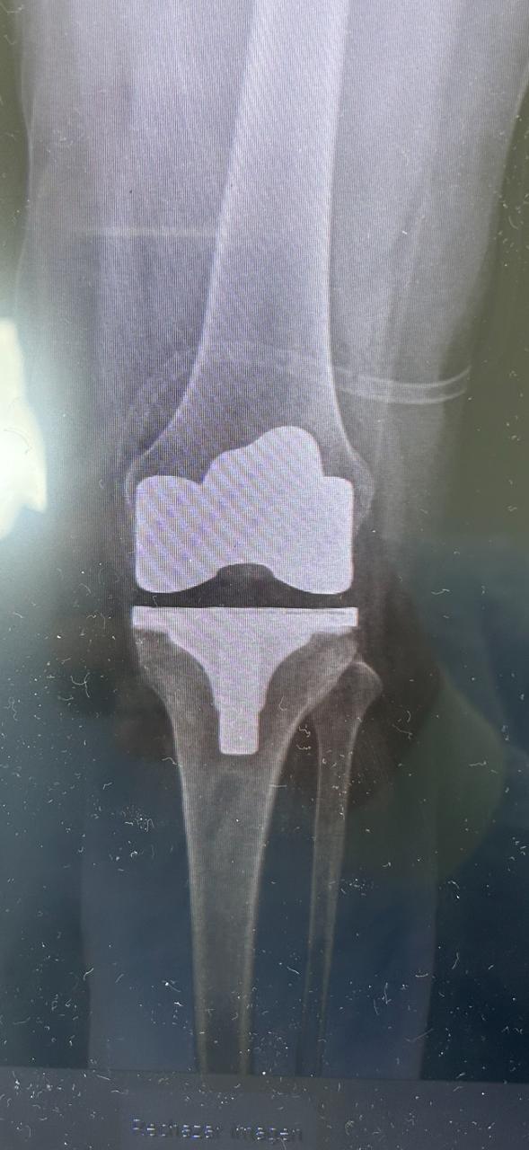 Volver a Caminar con Confianza. Cómo la Prótesis Total de Rodilla puede mejorar la movilidad, disminuir el dolor y recuperar la calidad de vida