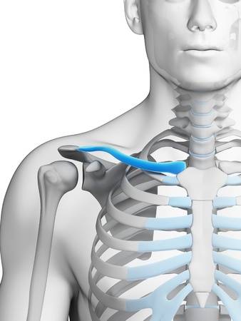 Mi hijo se fracturó la clavícula, ¿ necesita cirugía?